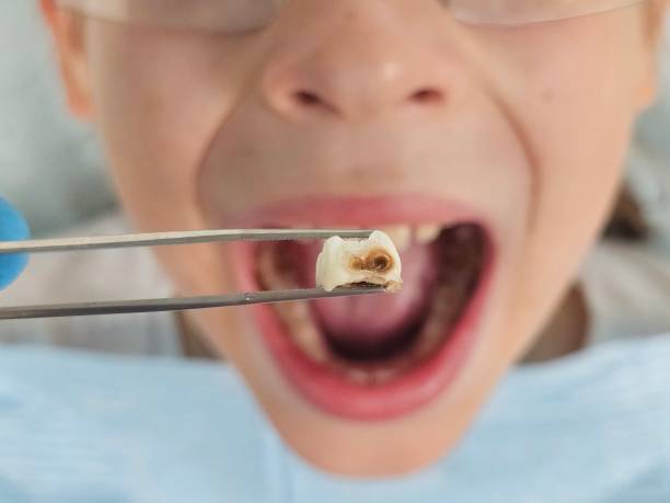 Best Emergency Treatment for Toothache in Minden, NV
